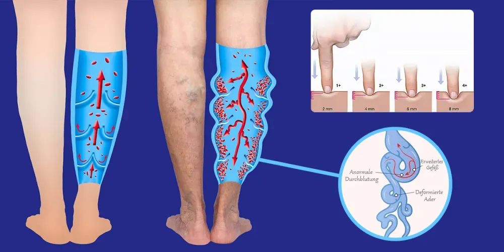 Akusoli Bloodflow DE C SM